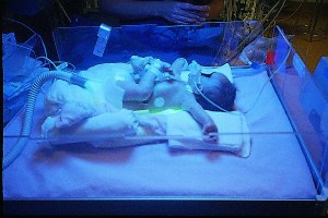 Ana under the blue light for Jaundice after her surgery.